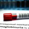 PAROXYSMAL NOCTURNAL HEMOGLOBINURIA (PNH) PATIENTS IN KYIV, UKRAINE